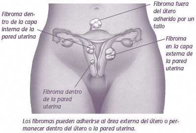 Fibroma uterino